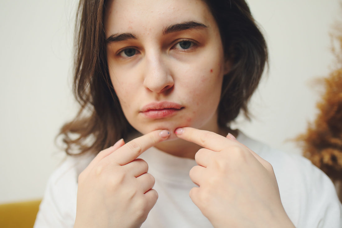 Top 5 Effective Ways to Treat Acne and Get Clear Skin